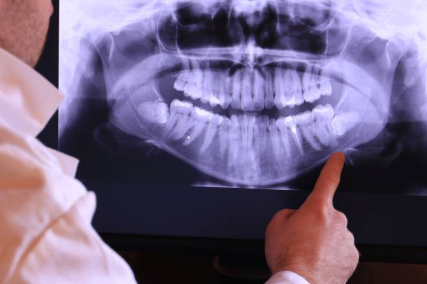 Best Knocked-Out Tooth (Avulsed Tooth) Treatment in Rion Center, MA